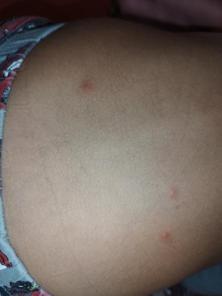 Bude mať môj syn kiahne?