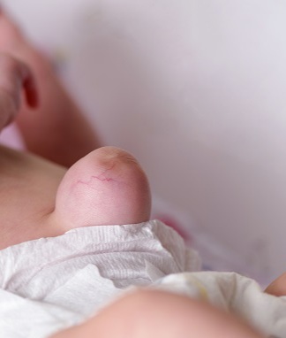 Hernia u dvojmesačného