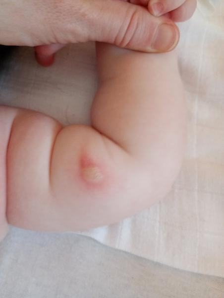 Neviete, čo spôsobuje vyrážku na ruke bábätka?