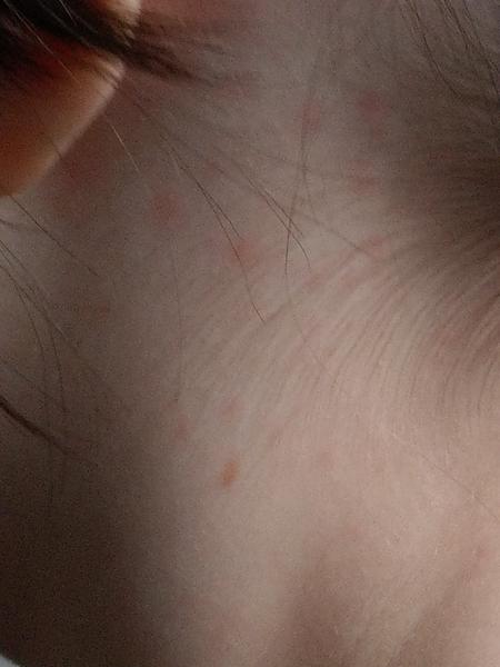 Svrbí vás hlava a máte vyrážky? Poradíme vám!