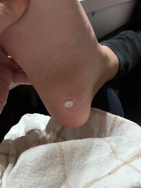 Ako správne ošetriť kurie oko u dieťaťa?