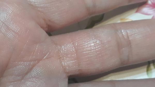 Pribudli mi čiary na prstoch na vnútornej strane