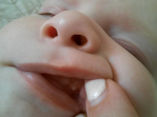 Sú to zúbky či afty?