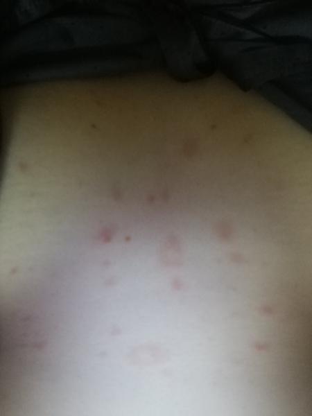 Sú červené fľaky na hrudi v tehotenstve normálne?