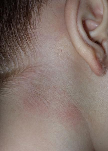 Čo spôsobuje vyrážky na krku a svrbenie?