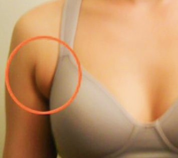 Dá sa táto nedokonalosť riešiť cvičením ?