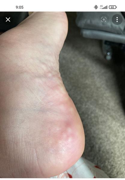 Tukové hrčky na päte