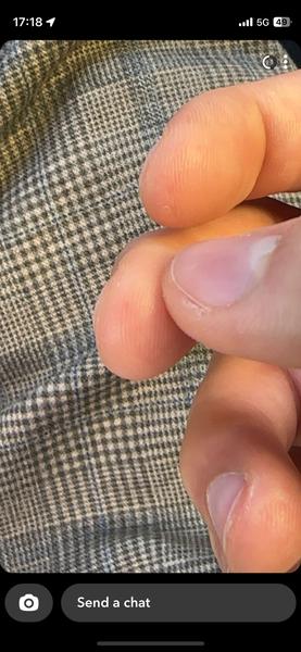 Fľaky na koncoch prstov: Čo môžu znamenať?