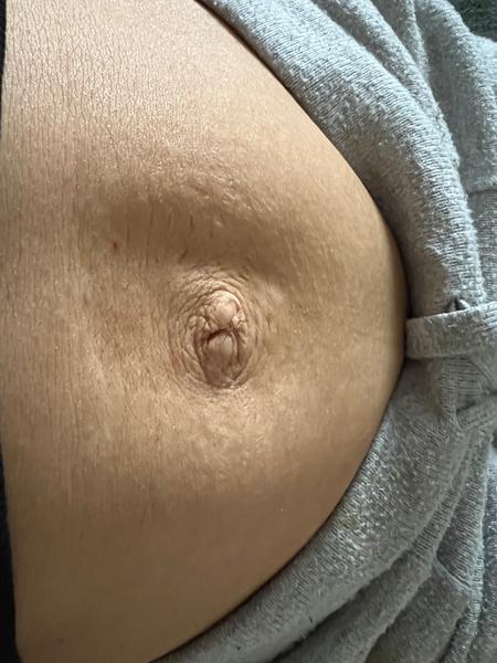 Čo s takýmto bruchom po diastáze?