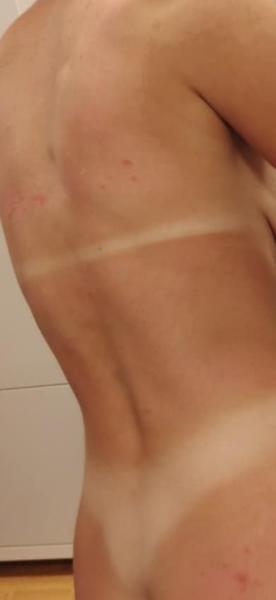 Čo spôsobilo vyrážky po návrate z Turecka?