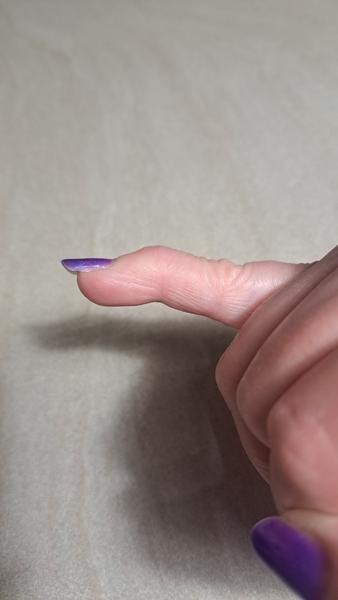 Opuchnutý malíček a bolesť po pracovnom úraze