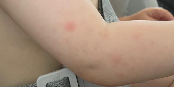 Prečo sa synček vysypal počas jedného dňa?