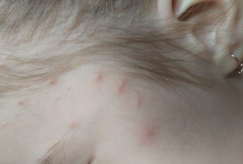 Môže mať očkované dieťa slabý priebeh kiahní?