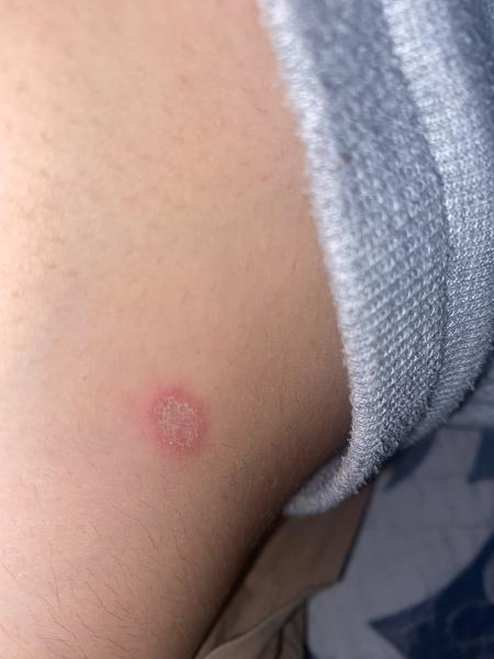 Svrbivé fľaky na pokožke. Môže ísť o psoriázu?