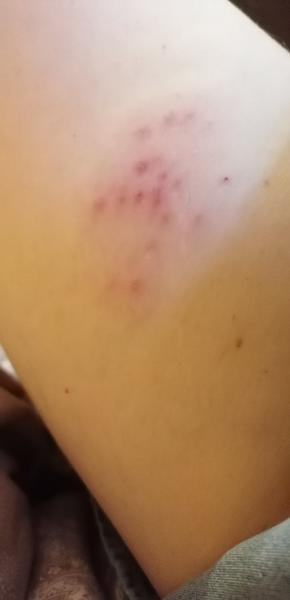 Štípance na nohe: Ako sa ich zbaviť?
