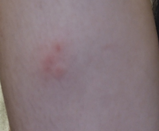 Sú to štípance od ploštice?