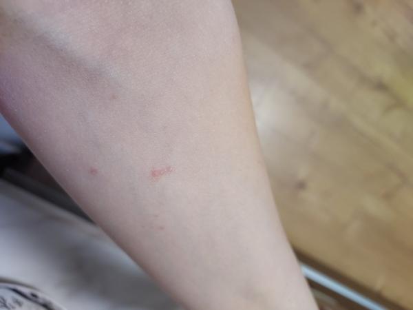 Začína mi ochorenie lichen ruben planus?