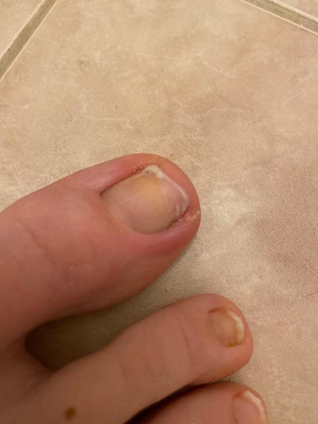 Čo to mám s nechtami?