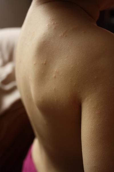 Čo sú toto za vyrážky?