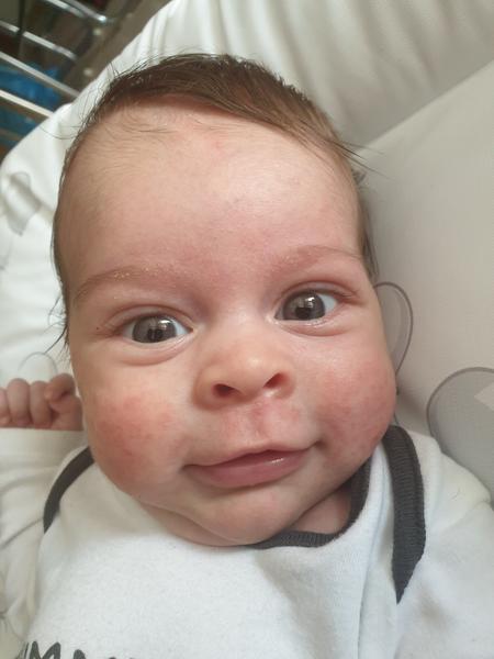 Červené pupáky na líčkach syna