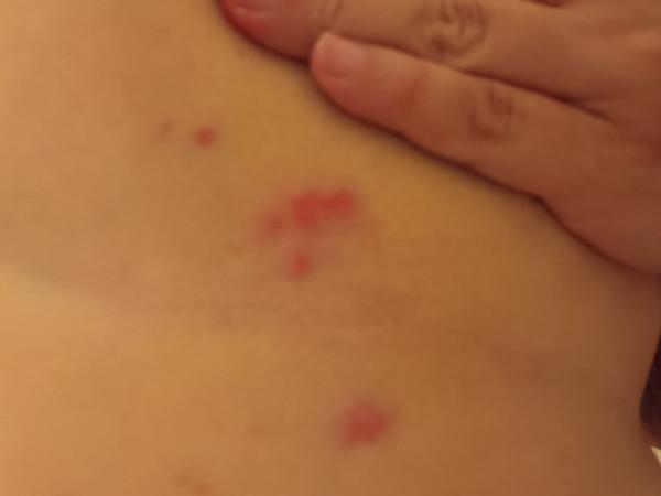 Čo spôsobuje vyrážky pod prsiami?