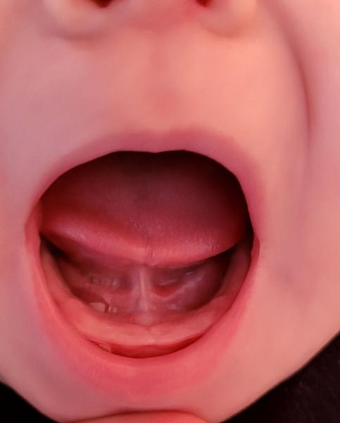 Ako vyzerajú ďasienka vašich detičiek, keď im idú zúbky?