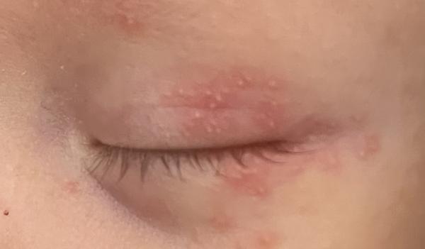 Čo má bábätko pri očku a ako to liečiť?