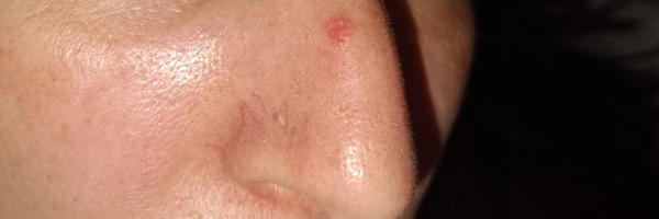 Je červený fľak na nose normálny?