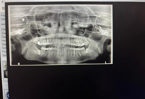 Vidíte na RTG akútne zubné problémy?