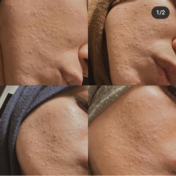 Mám problémy s pleťou