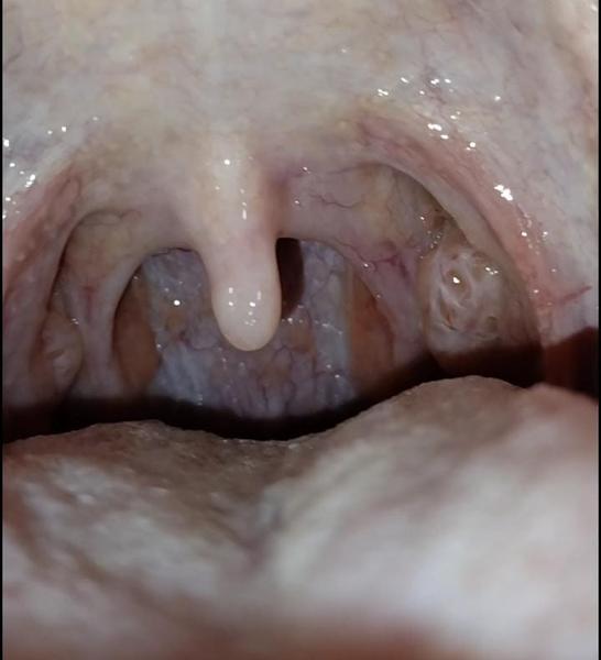 Čo mám s mandľami?