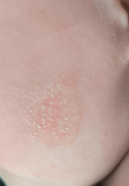 Ako liečiť vyrážku na líci u detí?