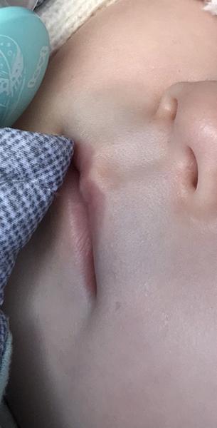 Má moja dcérka okolo úst modré cievy, alebo ide o srdcovú chorobu?