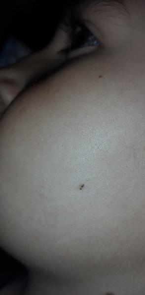 Môže byť znamienko na tvári melanóm?