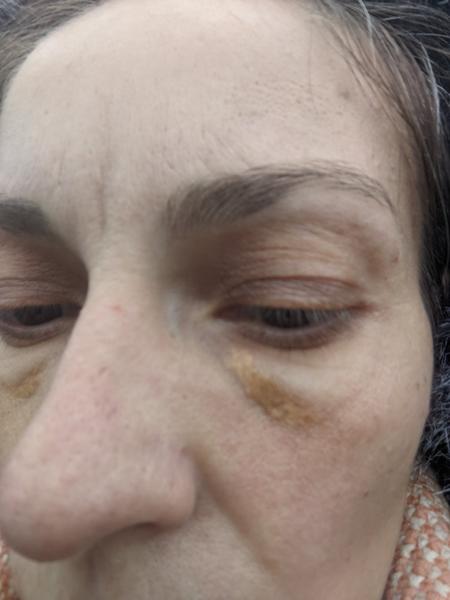 Príčiny žltých fľakov pod očami