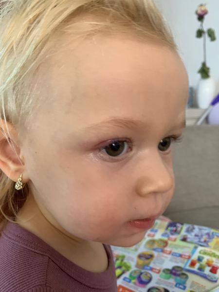 Má moja dcérka jačmeň v oku?