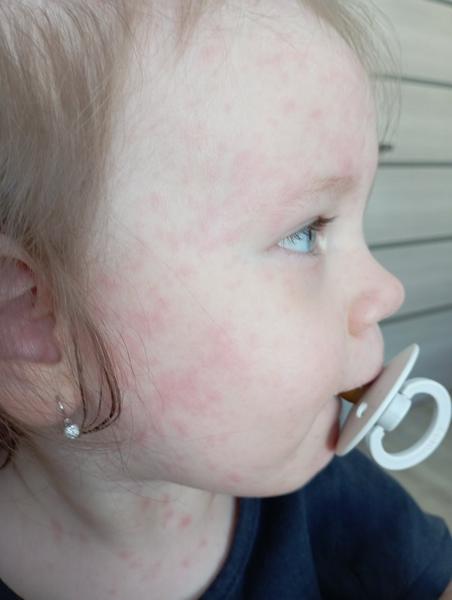 Dva dni vysoké horúčky a dnes výsyp. Ide o šiestu chorobu?