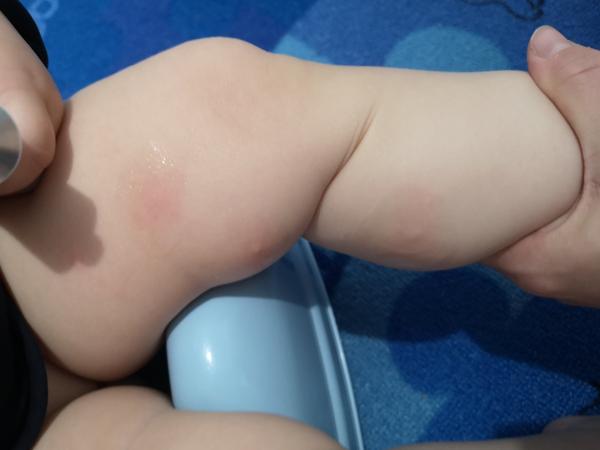 Štípance alebo vyrážky?