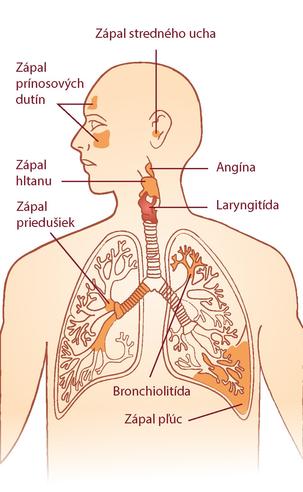 Akútna bronchiolitída Akútna bronchiolitída