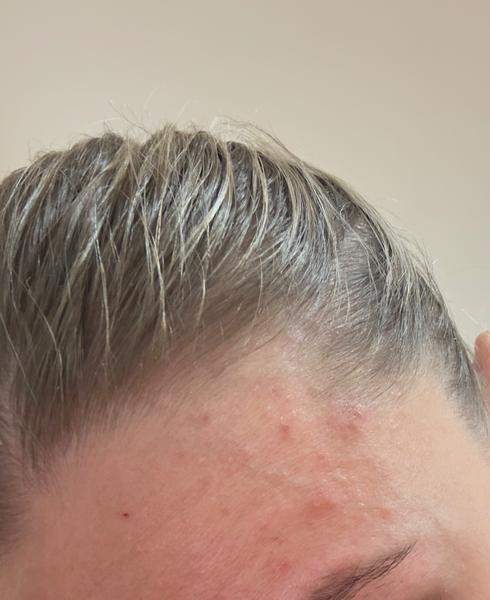 Príčiny a riešenia pre problematickú pleť