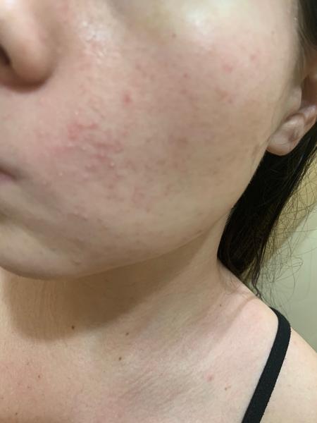 Ako sa zbaviť svrbiacich vyrážok na dekolte, rukách a tvári?