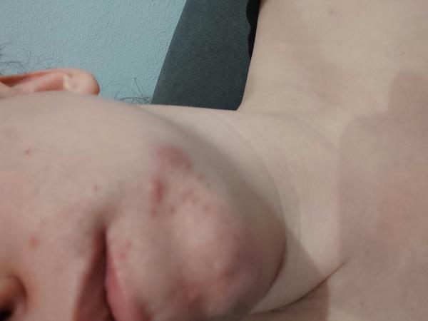 Ako sa zbavím vyrážok na brade?