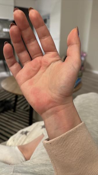 Čo spôsobuje opuchy rúk a tváre?