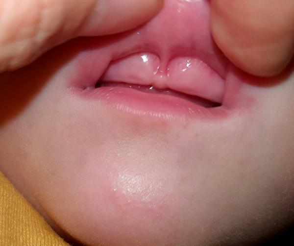 Ako vyzerali horné ďašná vašich detičiek, keď sa mi tlačili zúbky?