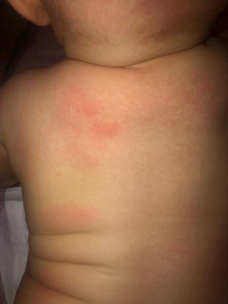 Aké fľaky má moje 8-mesačné bábo?