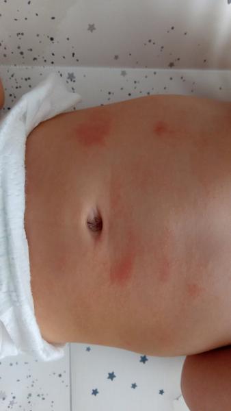 Ročný syn má už 2 týždne fľaky po rukách a na bruchu