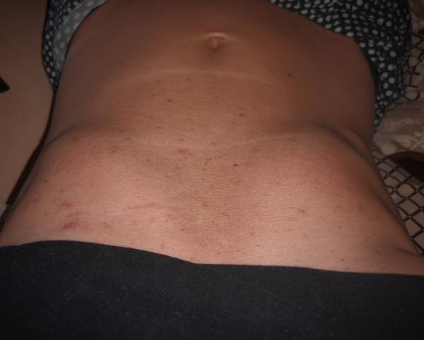 Kožné vyrážky na bruchu