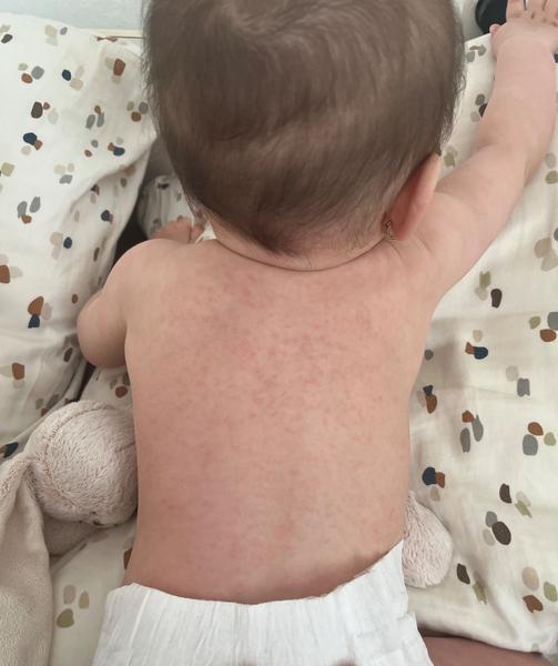 Môže to byť piata alebo šiesta choroba u bábätka?