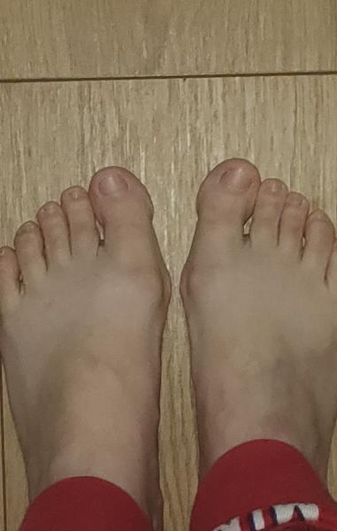 Sú toto začínajúce haluxy?