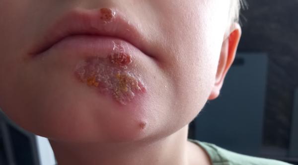 Ako ošetrovať chrasty po herpese?